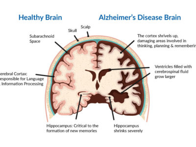 Alzheimer Disease , neuropedia