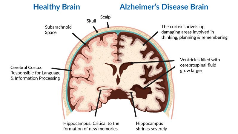 Alzheimer Disease , neuropedia