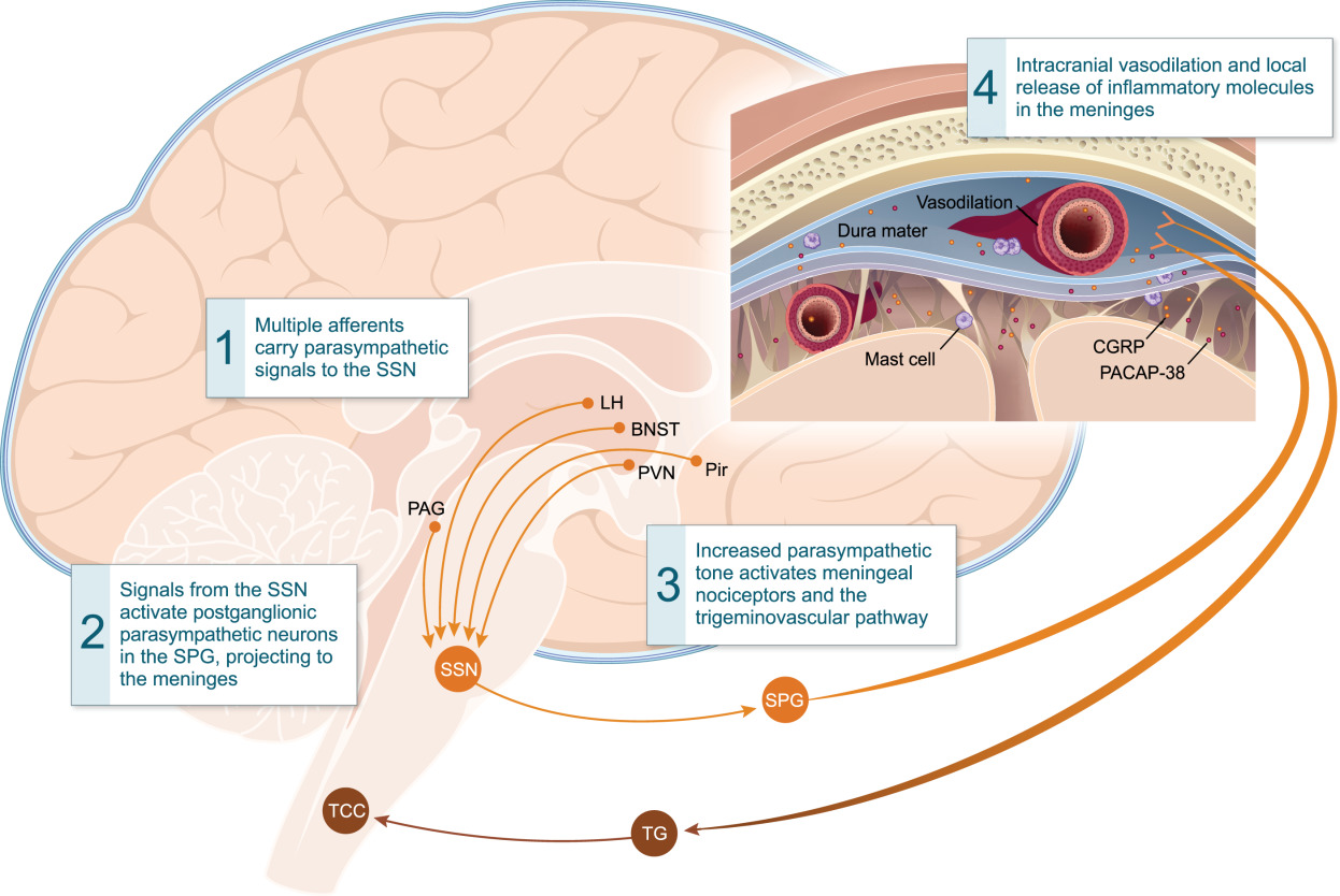 Migraine - Neuropedia - Neuropathology Migraine attacks