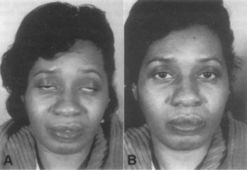 Figure 2: edrophonium test A bilateral ptosis in MG patient B IV edrophonium administration 