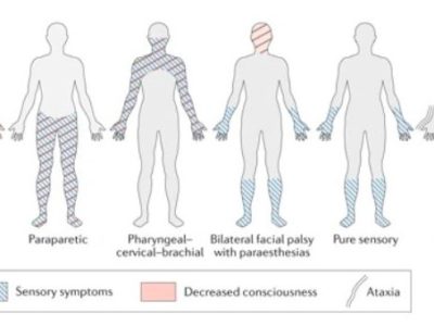 Guillain Barré Syndrome