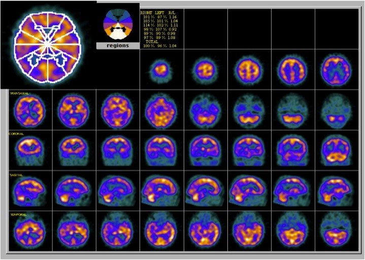 Alzheimer’s disease