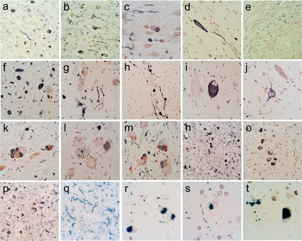 Immunohistochemical staining for α-synuclein in different brain regions. +ve immunostaining is black; the counterstain is neutral red. (a–e) The olfactory bulb & tract. An enlarged, abnormal neurite within the olfactory tract shown in (d). +ve fibers coursing in parallel array through the internal plexiform layer shown in (e). (f–j) The anterior medulla. The dorsal motor nucleus of the vagus nerve is shown in (f), the raphe nucleus in (g) and (i), the internal tract of the glossopharyngeal nerve in (h) and the lateral reticular nucleus in (j). (k–m) The locus ceruleus in the pons. (n–p) The amgydala. (q) The cingulate gyrus. (r) The middle temporal gyrus. (s) The middle frontal gyrus. (t) The inferior parietal lobule. Parkinson's Disease