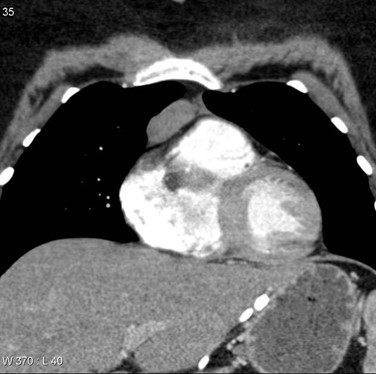 Figure 3: CT scan of the mediastinum of a young woman clinically demonstrate features of MG with anterior mediastinal thymoma type 2B, Case courtesy of Assoc Prof Frank Gaillard33.