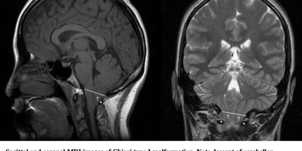 Chiari Type I Malformation - Pediatrics - Neurosurgery - Neuropedia