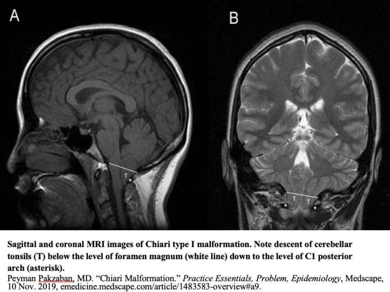 Chiari Type I Malformation - Pediatrics - Neurosurgery - Neuropedia