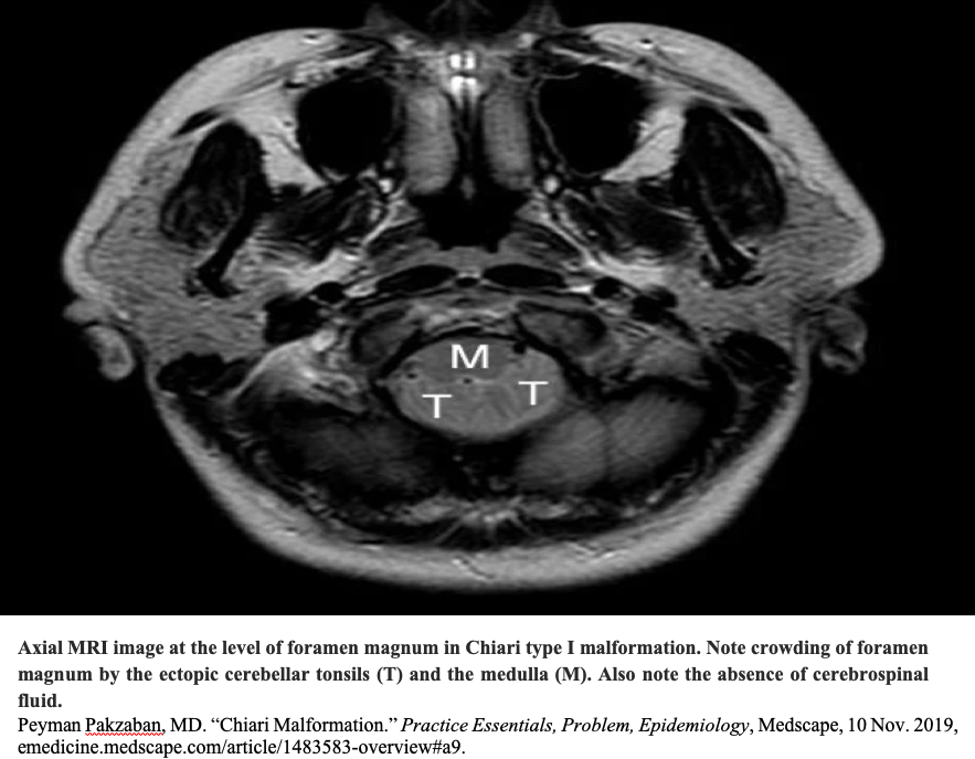 Axial MRI image at the level of foramen magnum in Chiari Type I Malformation