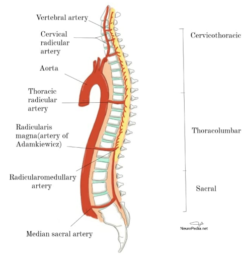 Spinal Cord Infarction - Neuropedia - Neuropathology