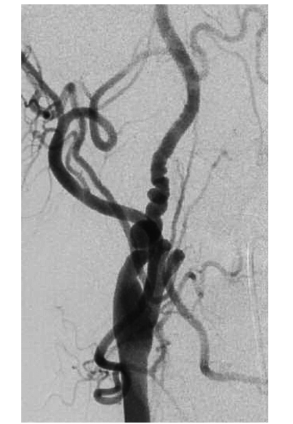 fibromuscular dysplasia
