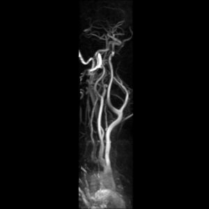 Angiography showing a large enhancing vascular conglomerate soft tissue mass splaying the external and internal carotid arteries sitting between them, representing a carotid body tumor.