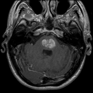 T1 weighted MRI showing pontine hemorrhage, which is considered as deep or non-lobar Intracerebral hemorrhage ICH