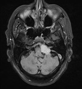 Cerebellopontine angle meningioma, Case courtesy of Dr Mostafa El-Feky