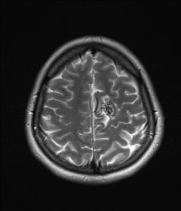 This is a T2 weighted MRI showing AV malformation at the current section for a patient that had a hemorrhagic stroke