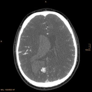 AV malformation that caused ICH in a young patient revealed by CTA axial section