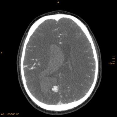 Intracerebral Hemorrhage (ICH) - Neuropedia - Neuropathy