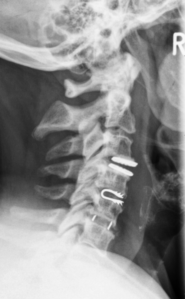 Spinal Biomechanics And Basics Of Spinal Instrumentation - Neuropedia