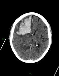 frontal lobe Intracerebral hemorrhage caused by coagulopathy