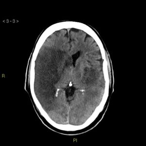 Middle Cerebral Artery (MCA) infarct