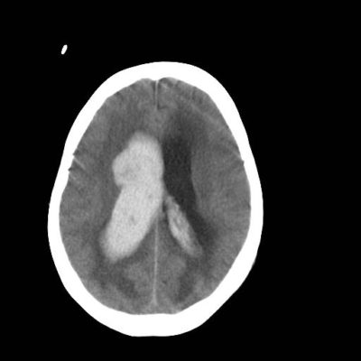 Intracerebral Hemorrhage (ICH) - Neuropedia - Neuropathy