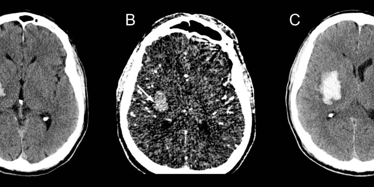 Intracerebral Hemorrhage (ICH) - Neuropedia - Neuropathy