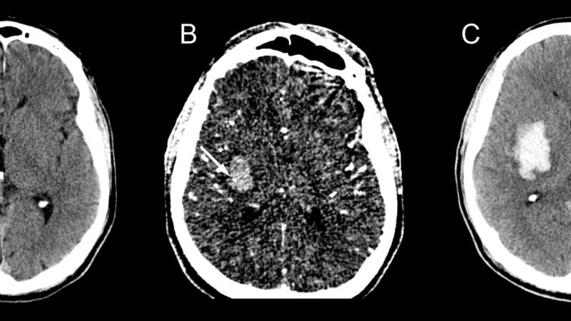 Intracerebral hemorrhage