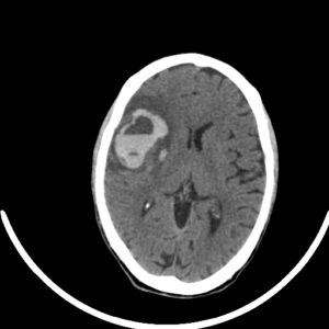 an early onset of ICH showing a blood-fluid level is evident that may be due to coagulation disorder or anticoagulation, with peripheral edema surrounding the hemorrhage