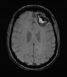 figure1: T1 weighted MRI showing a lobar Intracerebral hemorrhage ICH(20) 