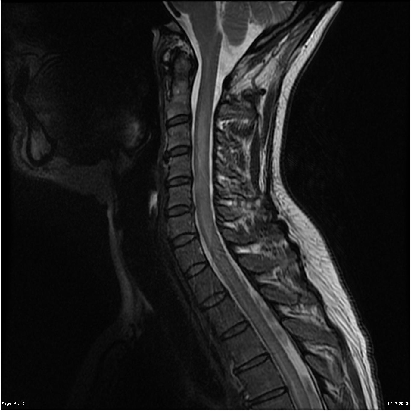 Neuromyelitis Optica Spectrum Disorder (NMOSD) - Neuropedia