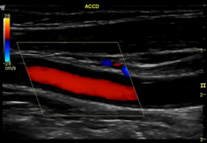 Carotid Doppler study demonstrates bilateral atherosclerotic mixed plaques on bulbs (calcified and hypoechoic), being more important on the left, where it is practically sub-occlusive (near occlusion of the ICA)