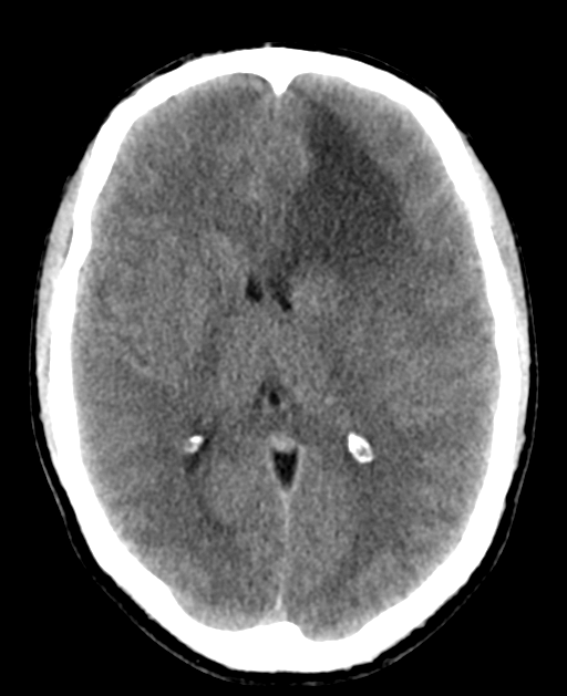 High Grade Glioma (Anaplastic Astrocytoma) - Neuropedia