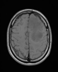 Figure (2):    MRI of ananplastic astrocytoma, Case courtesy of Dr Bruno Di Muzio,[7]