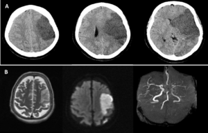 Figure 1. (A) Axial CT scan without contrast of the brain for a 60-years-old female patient presented with acute right-sided weakness showing a progression of MCA territory infarct with marked midline shift.18 (B) Axial T2 and DWI weighted MRI of the brain, and an MRA showing a well-defined area of high T2 signal with diffusion restriction in the left MCA territory. Loss of signal in the left MCA and its branches on the MRA.19