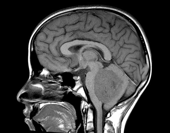 Primary Neuroectodermal Tumors (PNET)