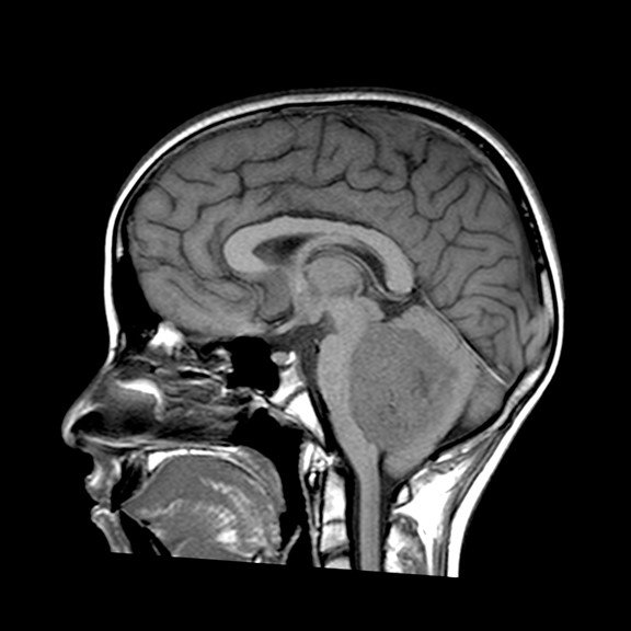 Primary Neuroectodermal Tumors (PNET)