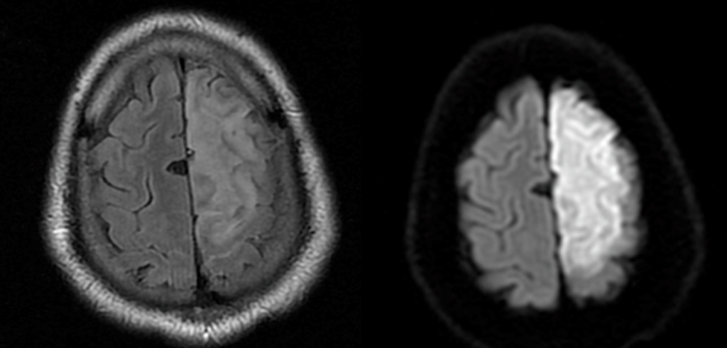 Mri Infarct Causes of Ischemic Stroke - Neuropedia stroke ischemic