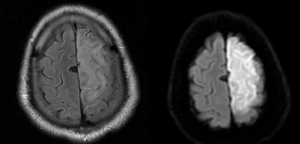 Figure 2. Axial Flair and DWI weighted MRI of the brain for a 50-years-old male presented with acute onset right lower limb weakness, showing DW imaging confirms acute infarction - territorial to left ACA.20