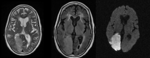 Figure 3. Axial T2. FLAIR and DWI MRI of the brain of an 85-years-old female presented with right-sided weakness and decreased vision showing right-sided PCA territory infarct showing hyperintense T2/FLAIR signals and diffusion restriction. Confluent high signal foci in T2 and FLAIR sequences at subcortical, centrum semiovale, and periventricular white matter of both cerebral hemispheres (Fazekas grade III) depict microvascular ischemic events.21
