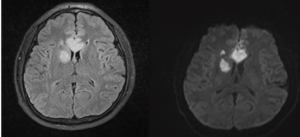 Figure 4. Axial DWI and FLAIR MRI for a 40-years-old male presented with an altered conscious level showing Extensive restricted diffusion in the rostrum, genu, and body of the corpus callosum. Further foci of restricted diffusion of variable size in the right internal capsule, corpus striatum, centrum semiovale, and insula.  All consistent with acute infarcts.24