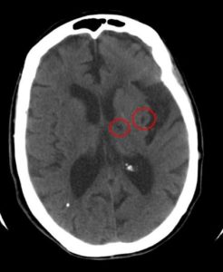 Figure 5. Axial CT without contrast of the brain showing two small hypoattenuating areas on left thalamic and insular region.29