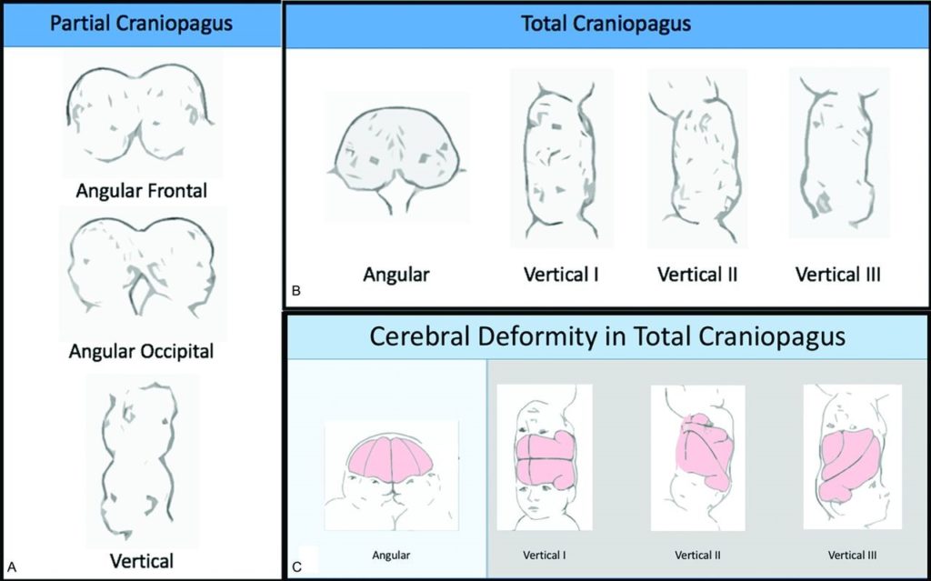 Craniopagus Twins Neuropedia Craniopagus Twins Neuropedia