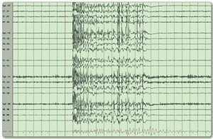  Figure (2): An EEG with a suppressed pattern of a patient after administering an anesthetic drug [13].Status Epilepticus , Neuropedia 