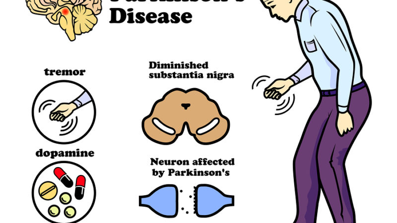 Parkinson’s disease
