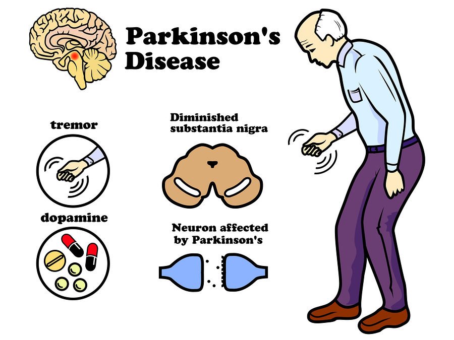 Parkinson’s disease