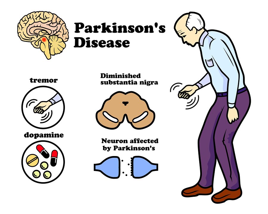 Parkinson S Disease Neuropedia   Bigstock 195525808 1 