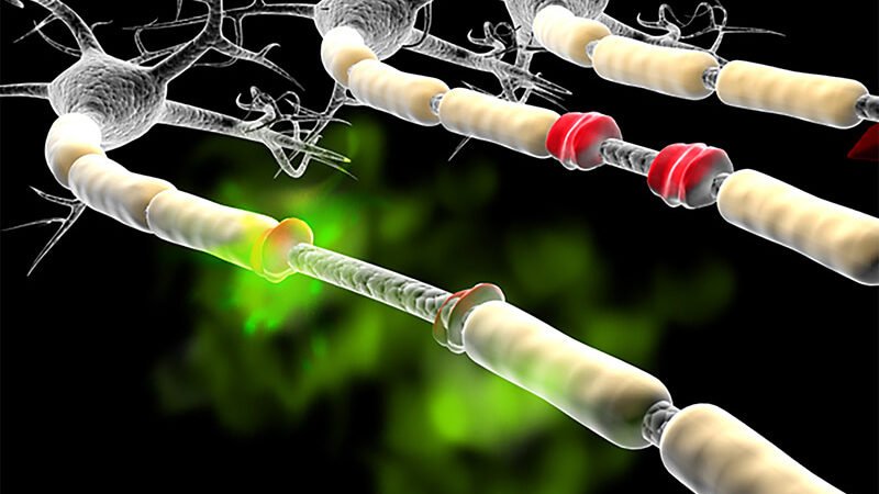 Multiple Sclerosis