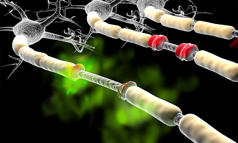 Multiple Sclerosis