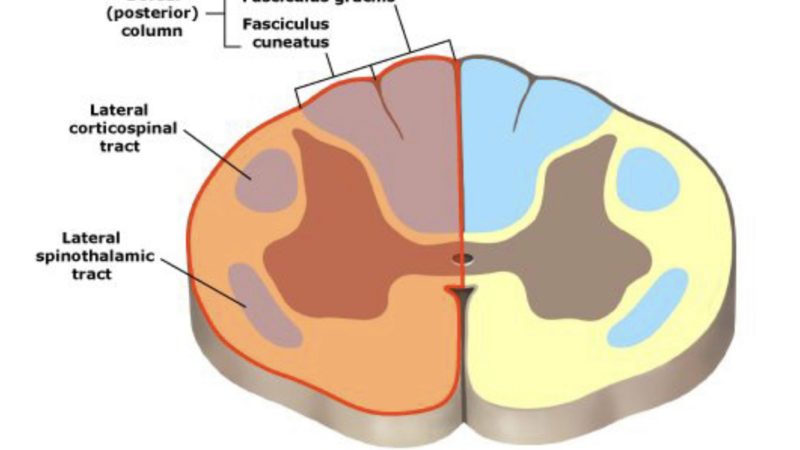Brown Sequard syndrome