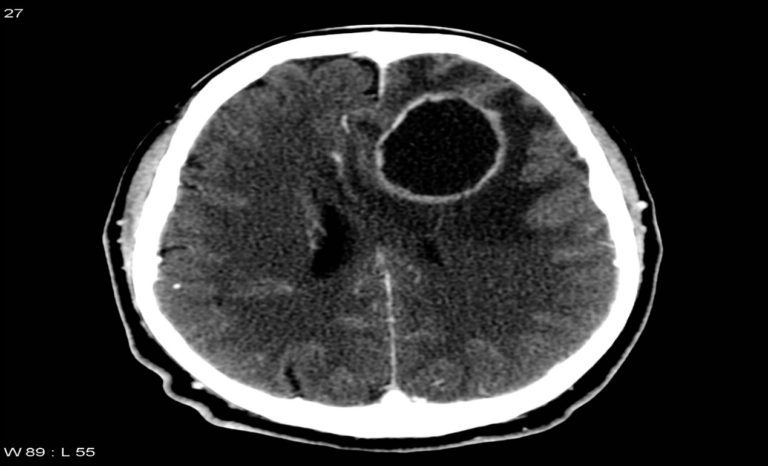Brain Abscess (BA) - Neuropedia