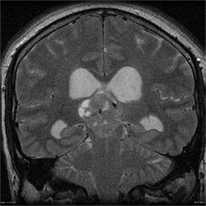 Pineal parenchymal tumors of intermediate differentiation