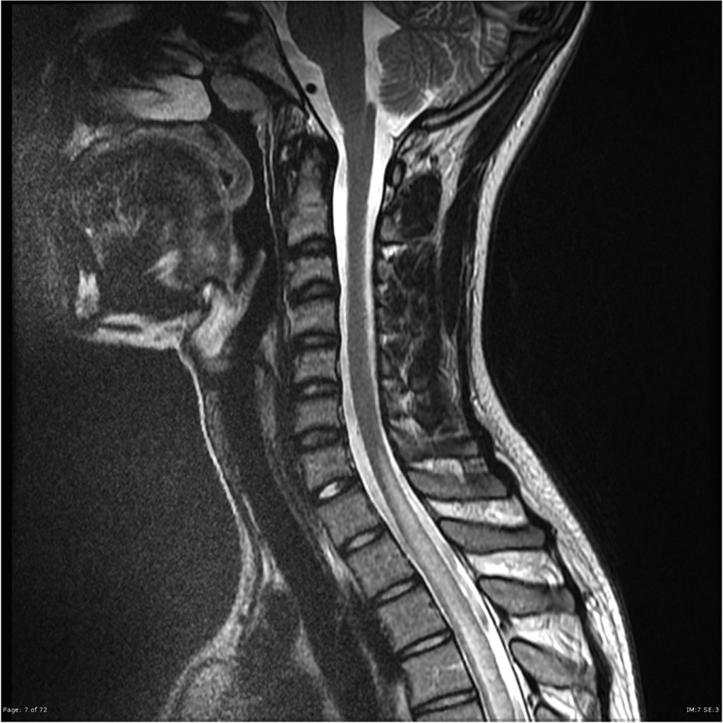 Transverse Myelitis (TM) - Neuropedia